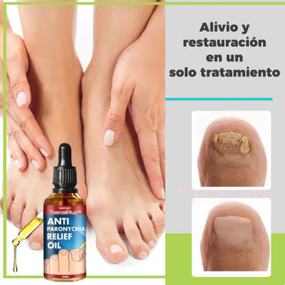 ToenailPlus™ - Elimina los hongos de raíz | Paga 1 lleva 2