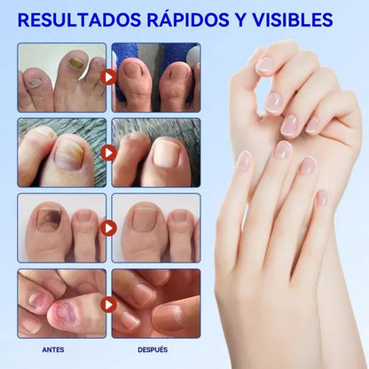 21 Parches Antimicóticos Para La Salud De Las Uñas Y Los Pie